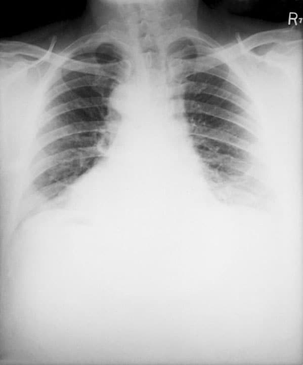 This posteroanterior (PA) chest x-ray was taken 4 months after the symptoms of anthrax started in a 46-year-old male.