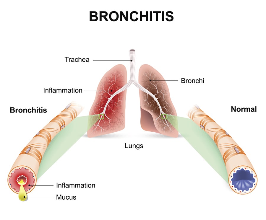 Chest Cold (Acute Bronchitis), Antibiotic Use
