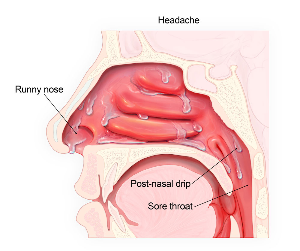 clogged nasal passages symptoms