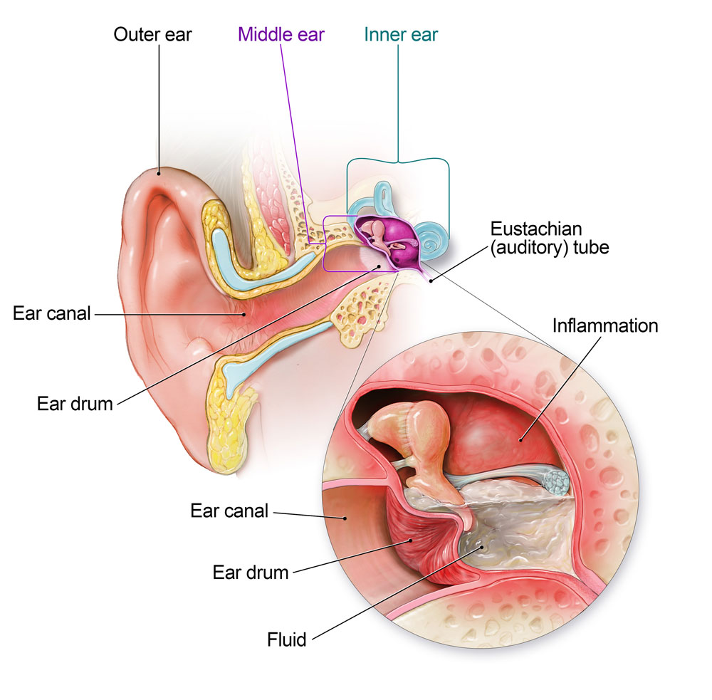 middle ear infection treatment