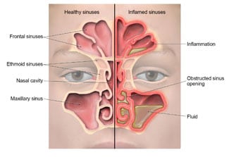 nasal and sinus congestion