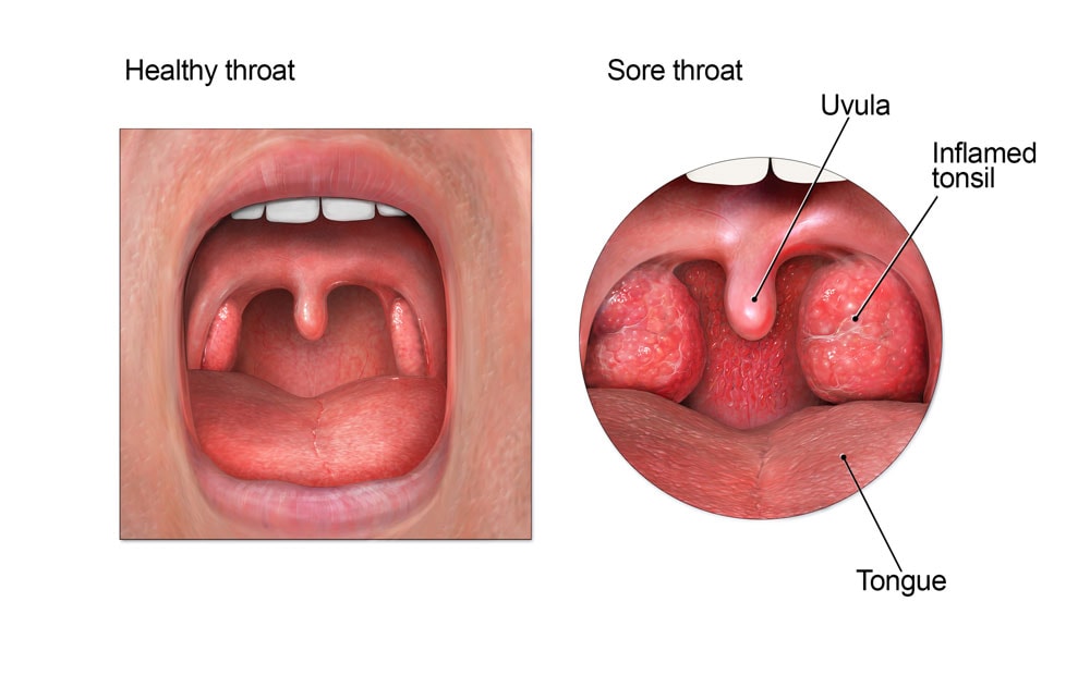 normal throat vs strep throat