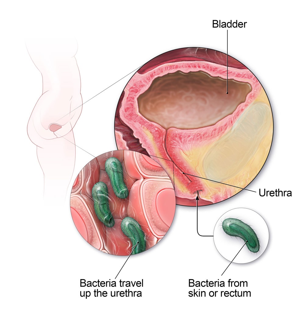 bladder infection urine