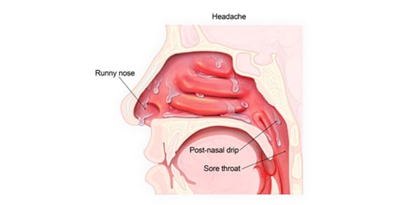 nasal congestion meaning