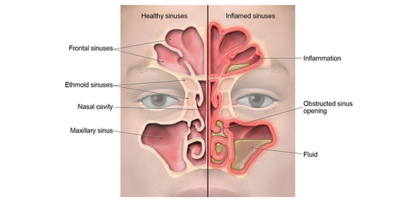 anatomy of sinus infection