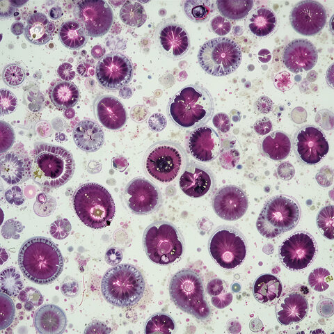 Cells displaying iron deficiency anemia.