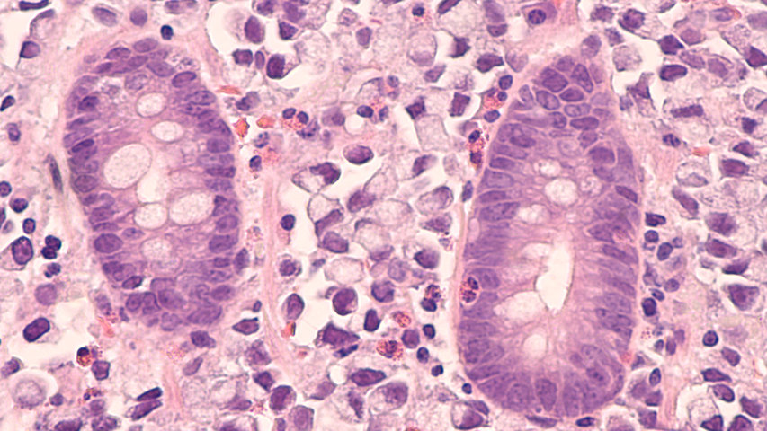 Illustration of gastric cancer cells.