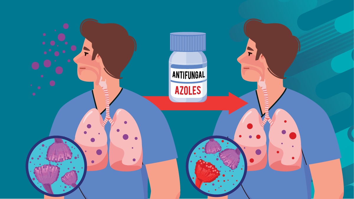 illustration of a person breathing in spores from A. fumigatus, represented in purple, with an arrow and image of bottle of azole medication, indicating use. image after use is the same person but shows that some of the spores inhaled in the lungs are red, to symbolize developing resistance.