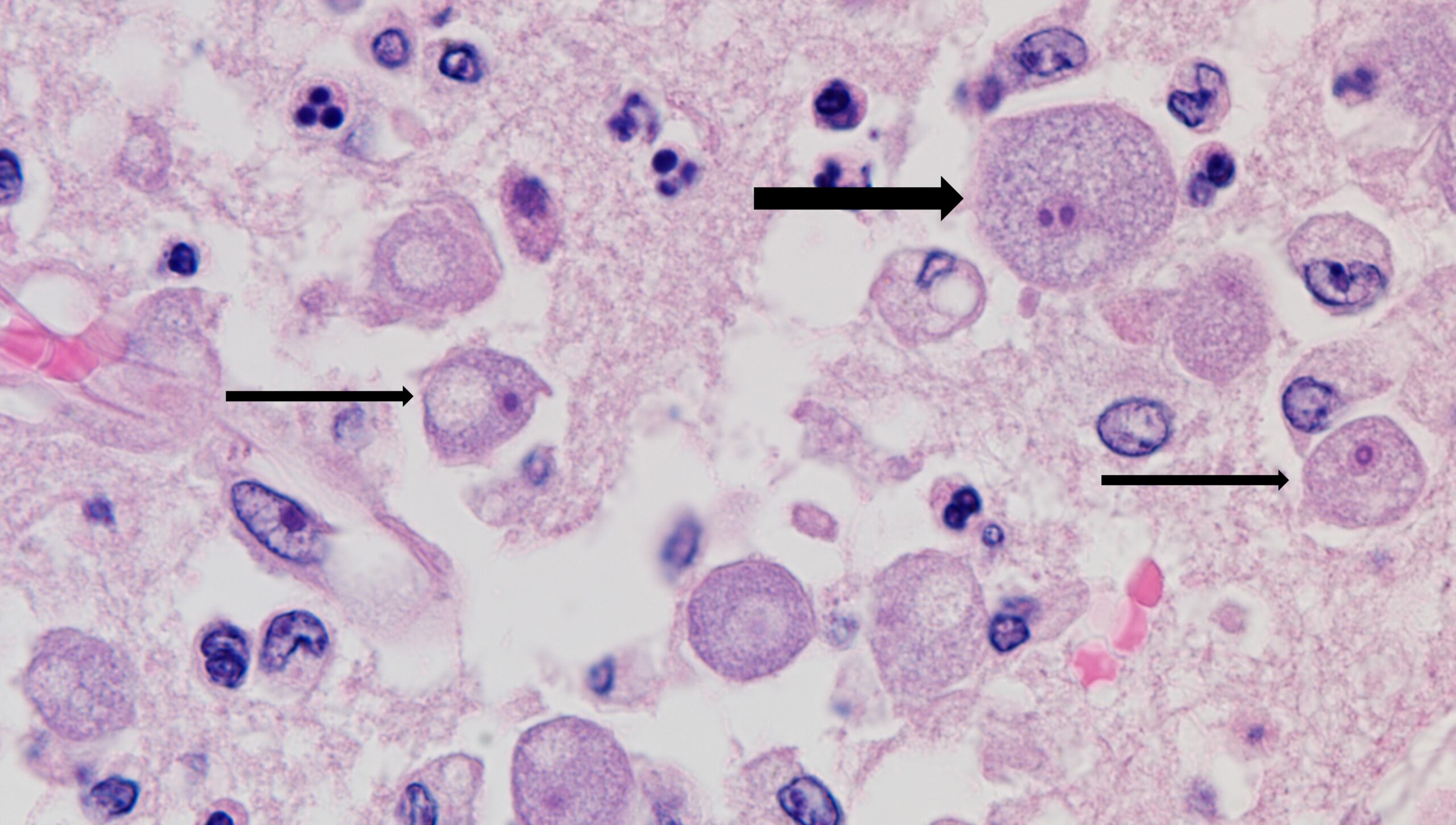 Balamuthia amebas in a patient&rsquo;s brain. Thin arrows point to the infectious form of the ameba.