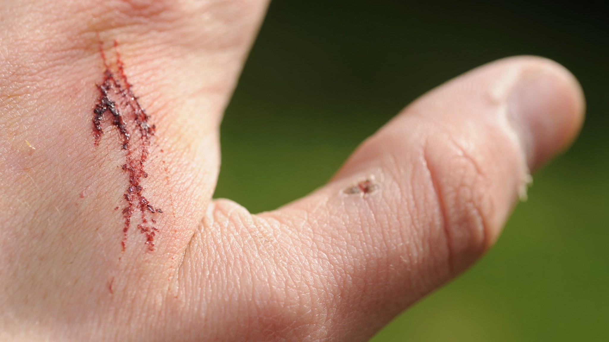 Closeup of a bloody wound on a person's hand.
