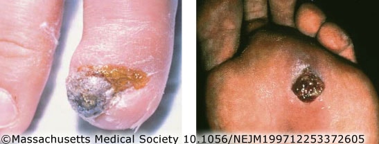Bacillary angiomatosis on fingers and toes.