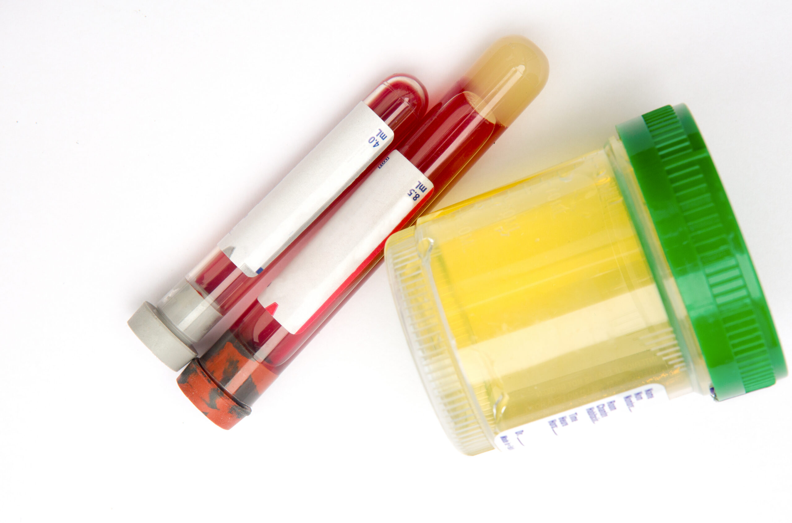 Vials of blood and urine