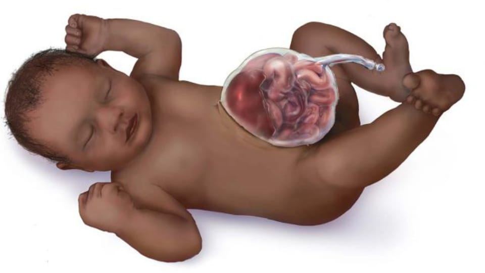 Ilustración de un bebé con onfalocele.