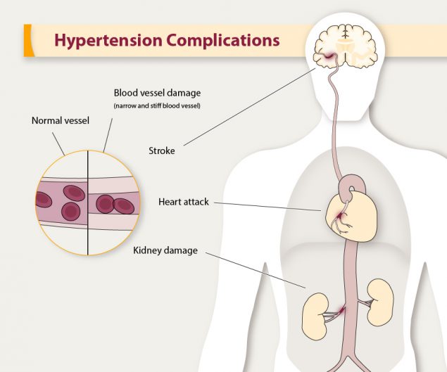 https://www.cdc.gov/bloodpressure/images/hypertension-complications-medium.jpg?_=19697