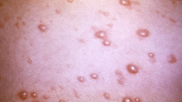 Close view of a patient’s skin surface with a pustular-vesicular rash due to the varicella-zoster virus (VZV) pathogen.
