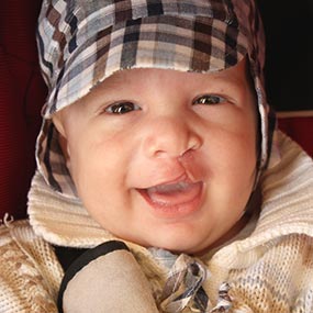 birth-defects Child with birth deffect