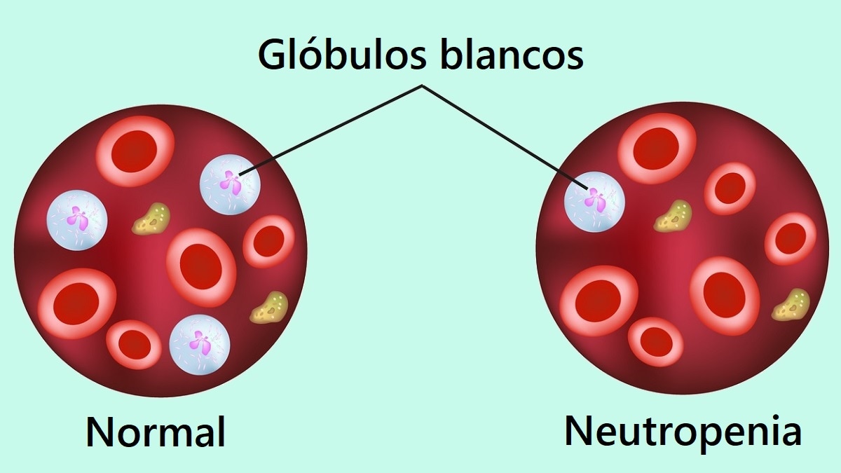 Glóbulos blancos normales y neutropenia