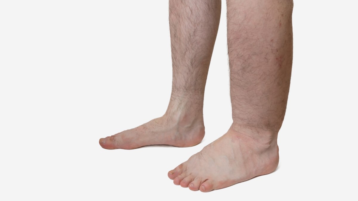 Photo of a person with lymphedema in the left leg