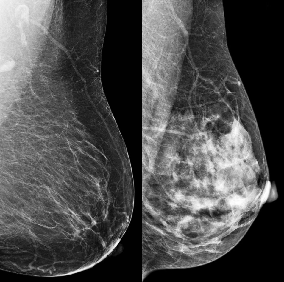 do fibrocystic breast changes lead to cancer