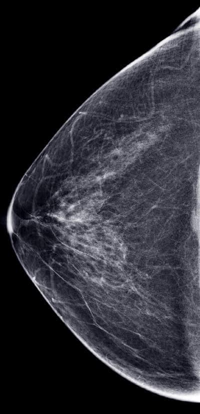 What Is a Mammogram?