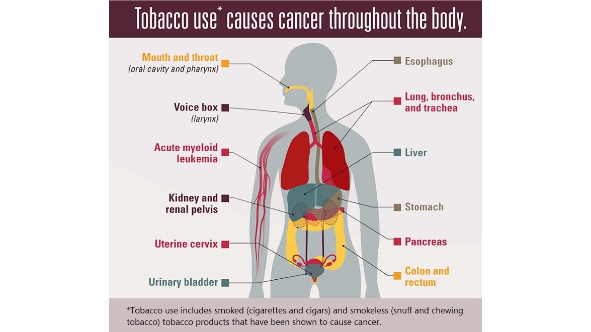 Tobacco use causes cancer throughout the body. Tobacco use includes smoked (cigarettes and cigars) and smokeless (snuff and chewing tobacco) tobacco products that have been shown to cause cancer.