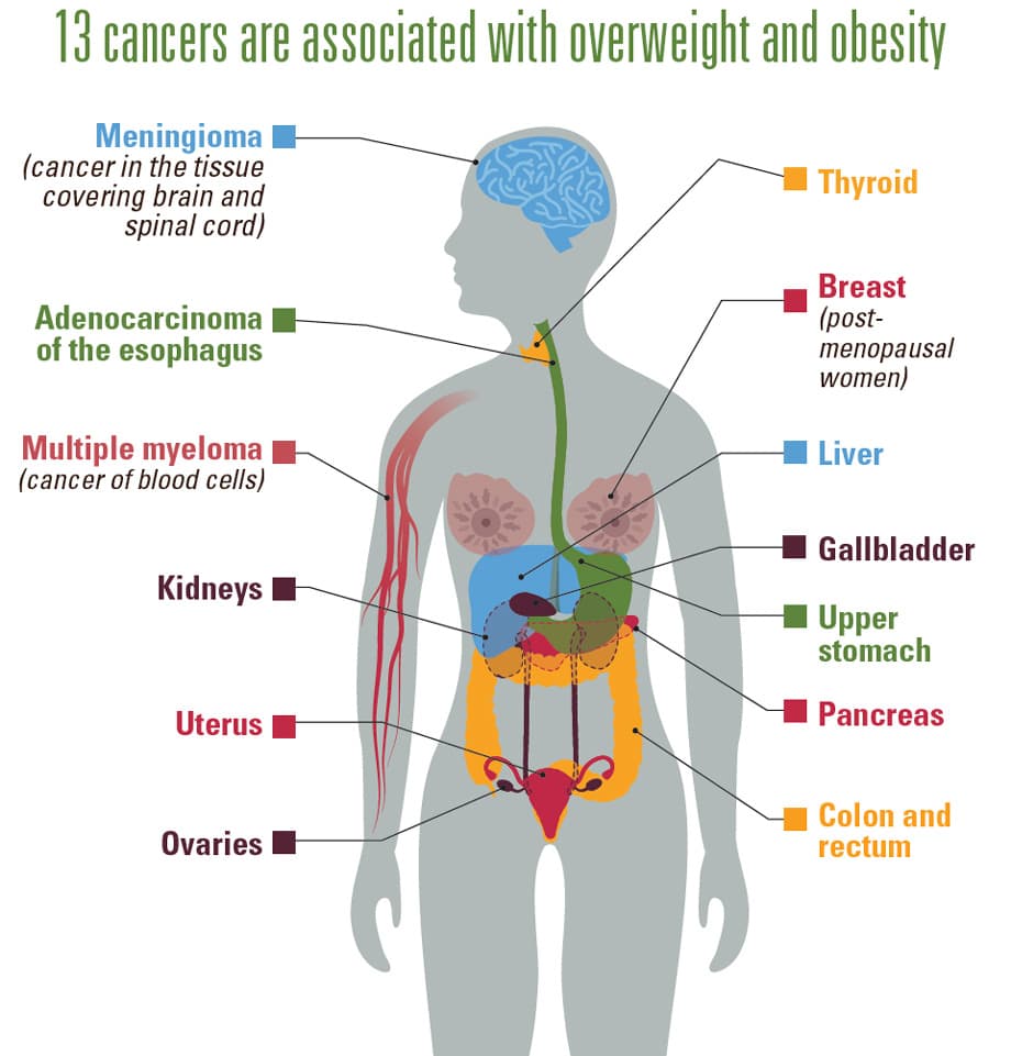 Obesity And Cancer CDC