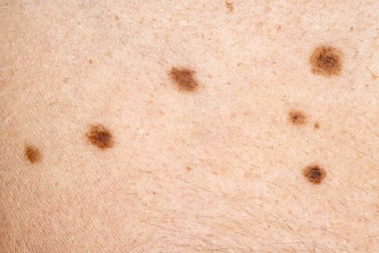 Skin cancer on leg: Appearance and more