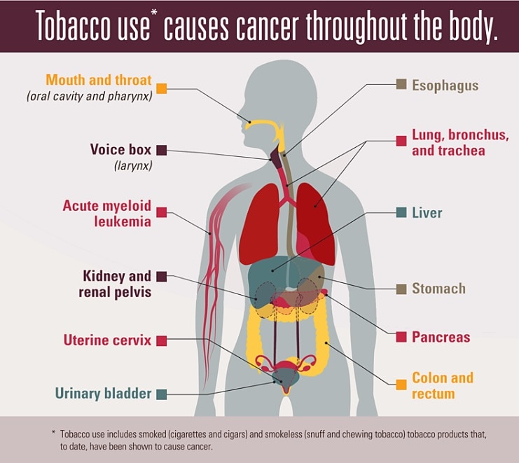 what percentage of throat cancer is caused by smoking