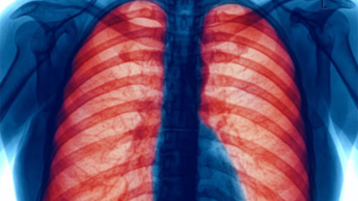 Blue Xray showing red lungs and ribcage.