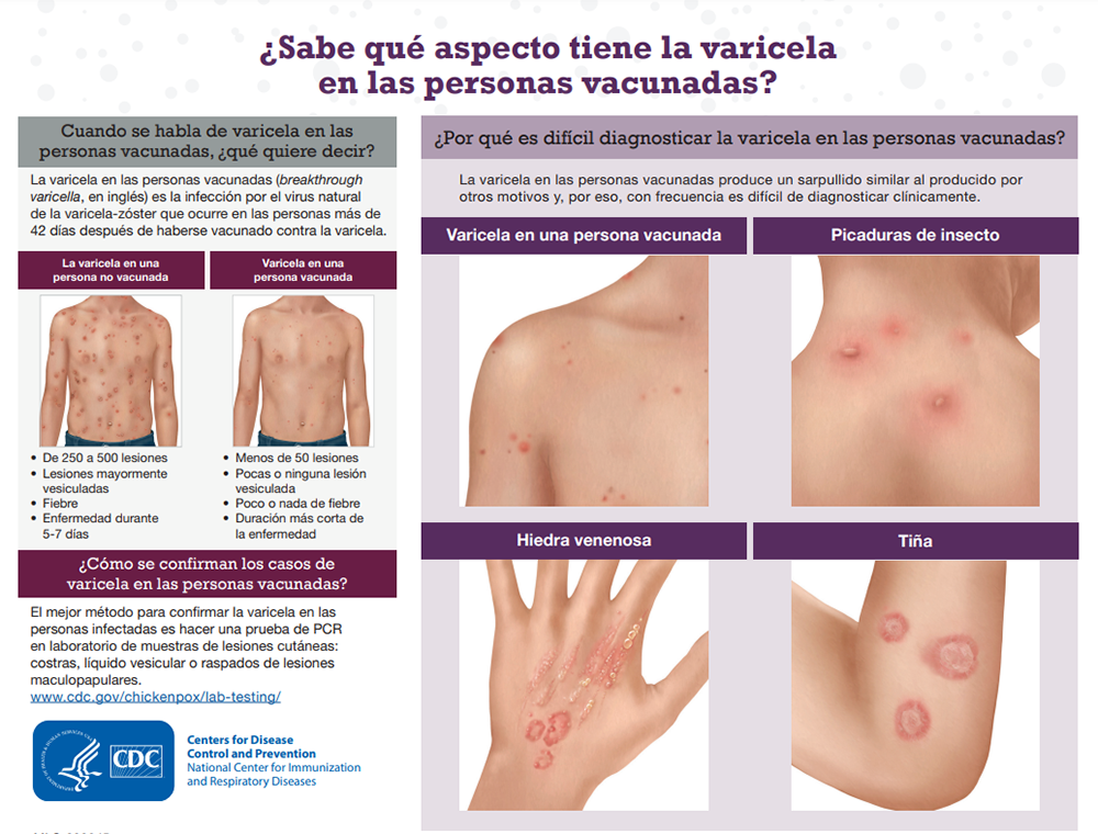 breakthrough varicella graphic (spanish)