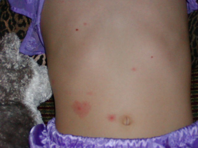 Photos Of Chickenpox Chickenpox Varicella CDC