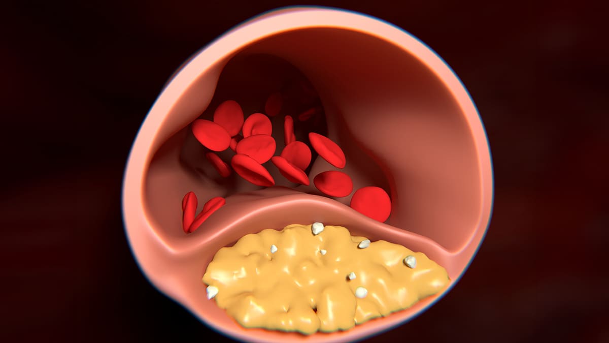 hdl and ldl cholesterol levels