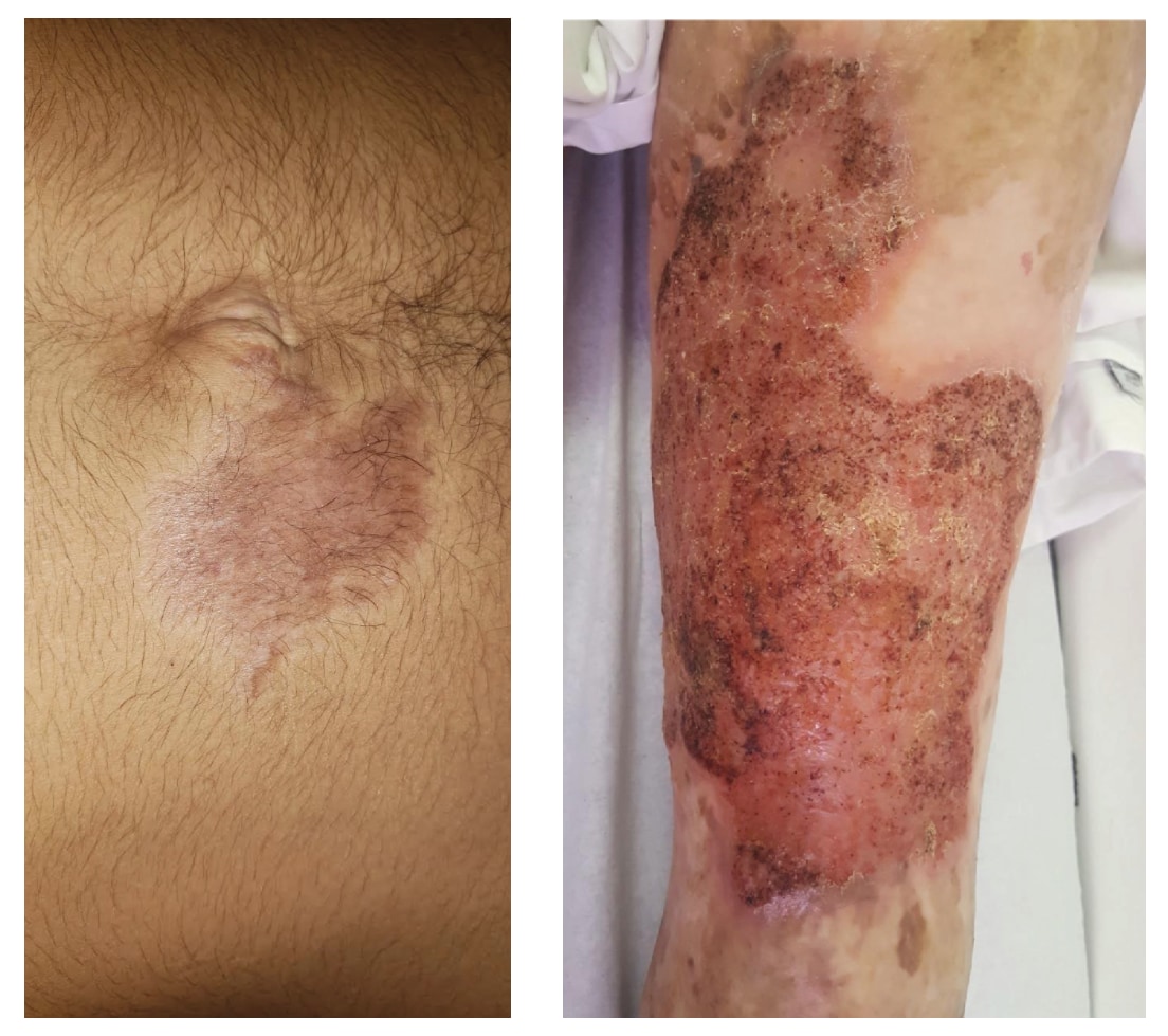 Early and late stage of chromoblastomycosis infection.