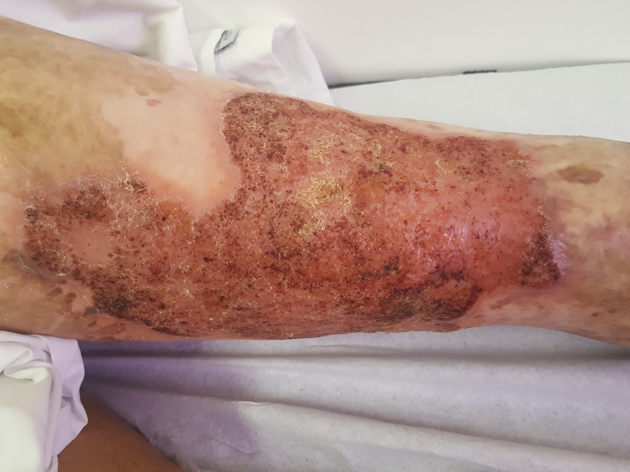 An image showing the impact of chromoblastomycosis on Gustavo's leg. The disease shows lesions and scars on his leg.