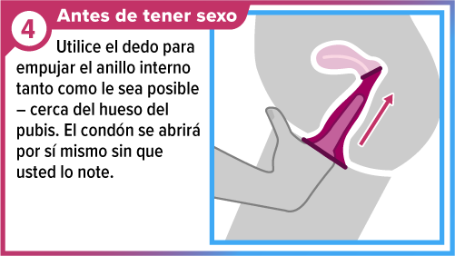 Dedo insertando el condón femenino dentro de la vagina.