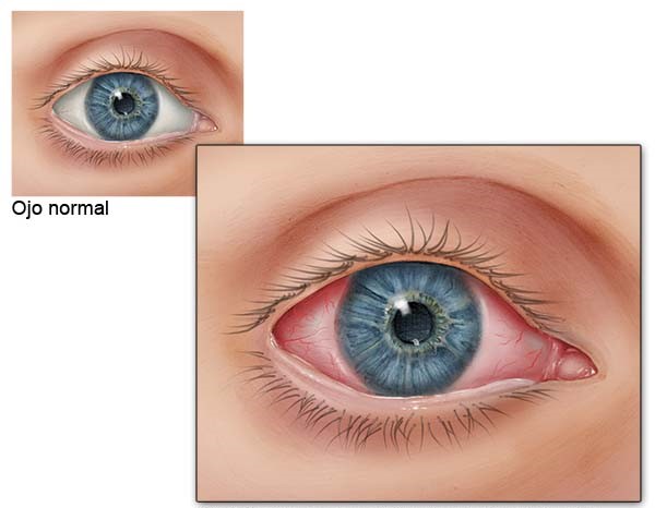 Ojo normal comparado con un ojo con conjuntiva inflamada (la capa fina sobre la parte blance del ojo) Esto es un síntoma de conjuntivitis.