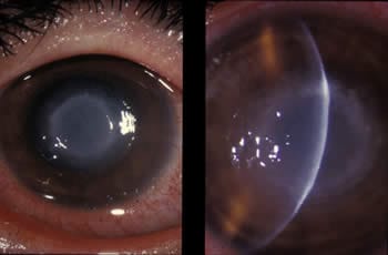 Eye infection from Acanthamoeba causing inflammation of the stroma and lens cloudiness
