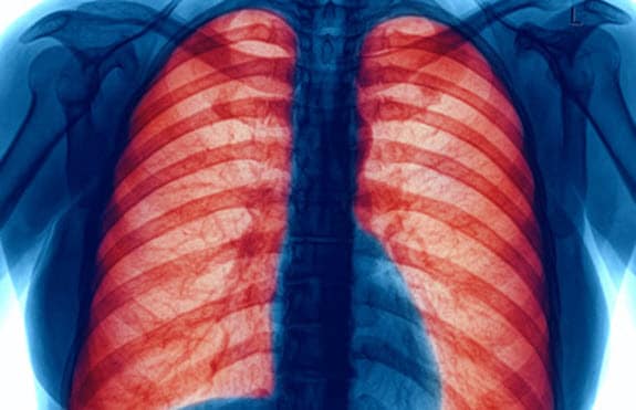 X-ray of lungs