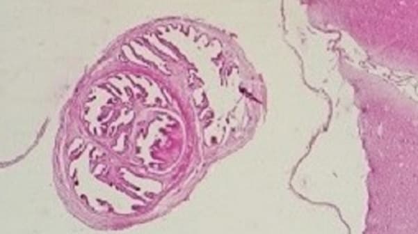 cysticercosis