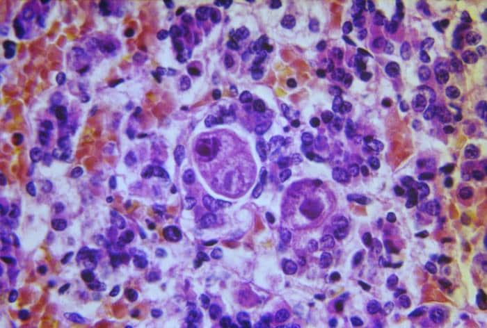 Photomicrograph of a section of pituitary gland tissue with cells from cytomegalic inclusion disease caused by the cytomegalovirus. Source: CDC Public Health Image Library.