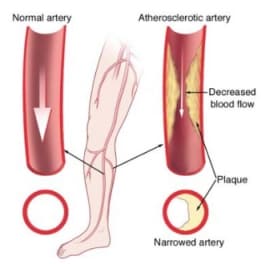 coronary artery disease causes