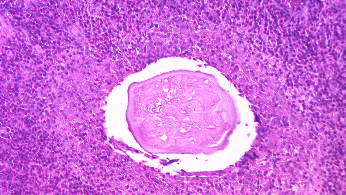 Eye tissue specimen showing Dirofilaria sp. nematode, or roundworm, magnified.