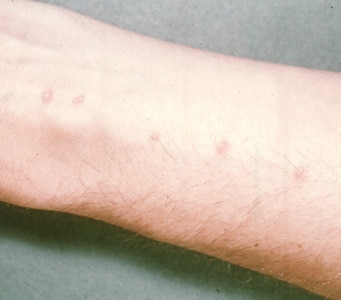 Figure A: Skin of a patient showing the inflammatory response to 