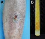 Novel Mycobacterium gordonae–like infection in a 63-year-old man in China. A) Verrucous dull nodule on the left shin of the patient. B) Mycobacterium colonies grown on Löwenstein–Jensen medium.