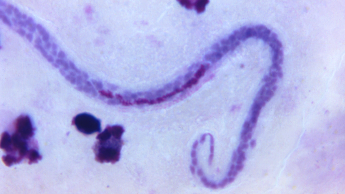 Wuchereria bancrofti microfilaria, a leading cause of LF