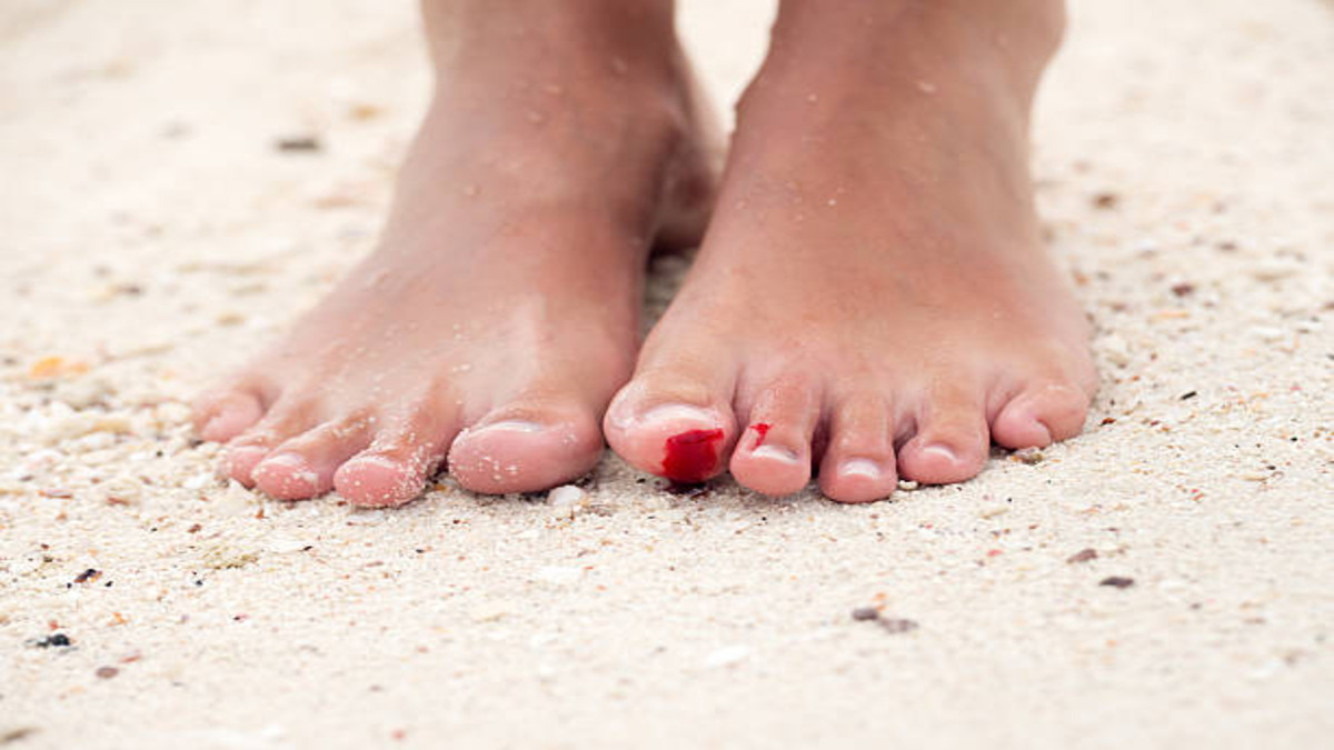 one pair of feet shown with an injury standing on beach sand