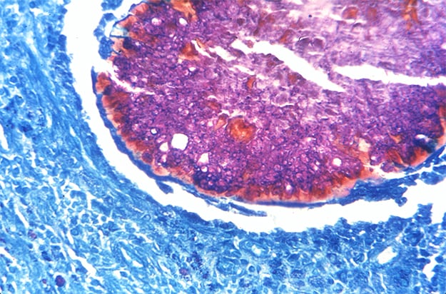 Histopathologic appearance of Black grain mycetoma, a fungal pathogen which  enters the human body through a traumatic wound, 1972. Image courtesy  CDC/Dr. Libero Ajello Stock Photo - Alamy