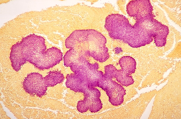 Histopathologic appearance of “black grain mycetoma” due to Madurella mycetomatis using a Gridley stain.
