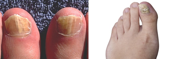 Close-up of a foot with nail fungus on a wooden background. Nail treatment  before and after. Onycholysis: detachment of the nail from the nail bed.  Photos | Adobe Stock
