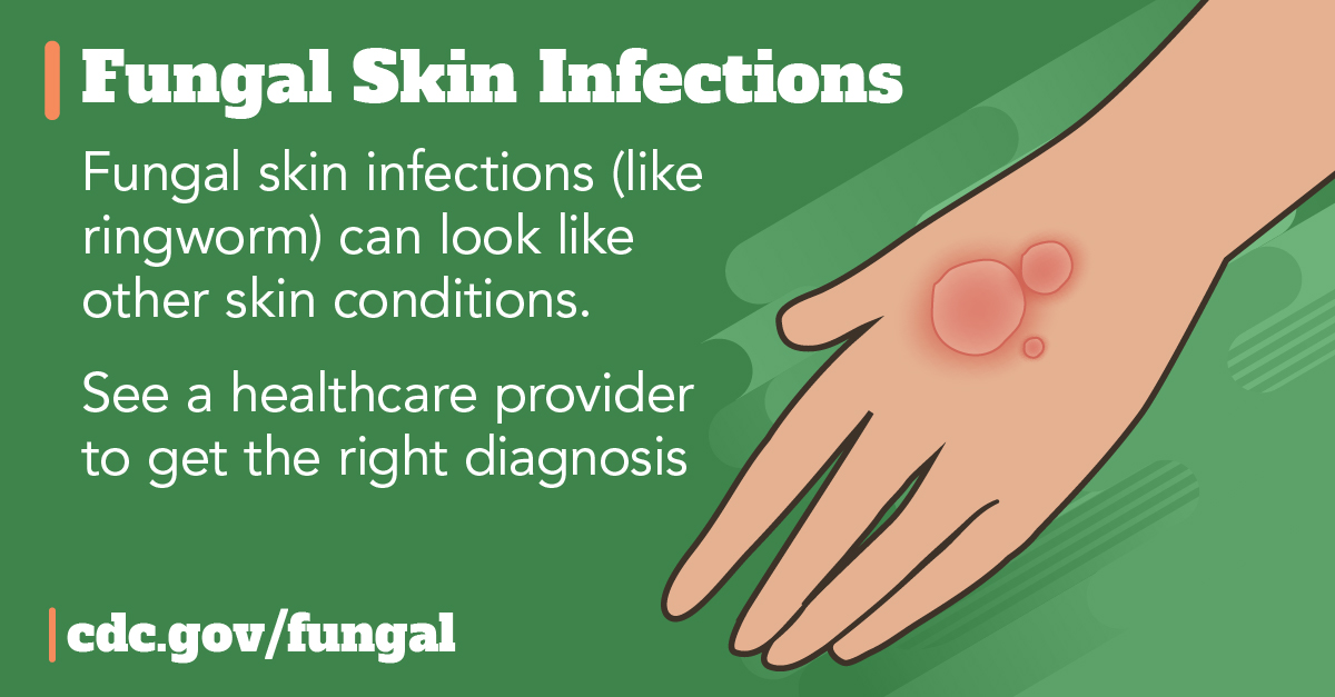 Text: Fungal skin infections (like ringworm) can look like other skin conditions. Talk to your healthcare provider to get the right treatment and diagnosis. Graphic shows a hand with ringworm infection.